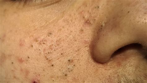Blackheads on youtube videos. Things To Know About Blackheads on youtube videos. 
